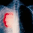  Alertan por aumento de  pacientes con cáncer de pulmón