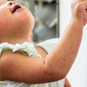  Hospital Infantil fortalece  vigilancia contra el sarampión