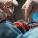  Falta la cultura de donación de órganos
