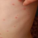  Acciones preventivas aplica autoridades de salud por casos de varicela detectados en la zona