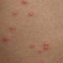  Aumenta casos de varicela  pero se descarta alerta