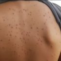  ¡Alerta! Reportan un nuevo brote de varicela en Tijuana
