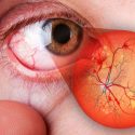  Aumentan enfermedades de la retina por diabetes, en pacientes de todas las edades.