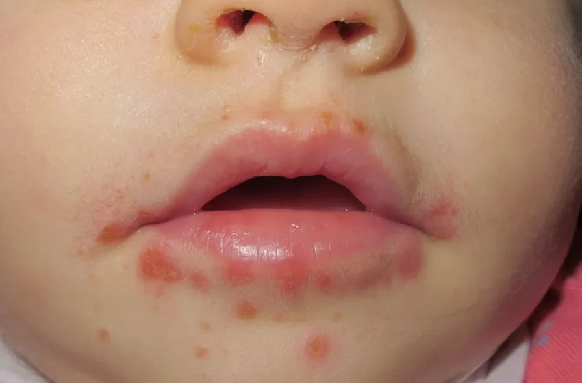 Casi 130 casos de virus manos-pies-boca en niños