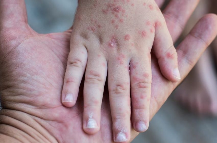 Identifica CREDE 3 instituciones con casos de virus Coxsackie, descartan contagio masivo.