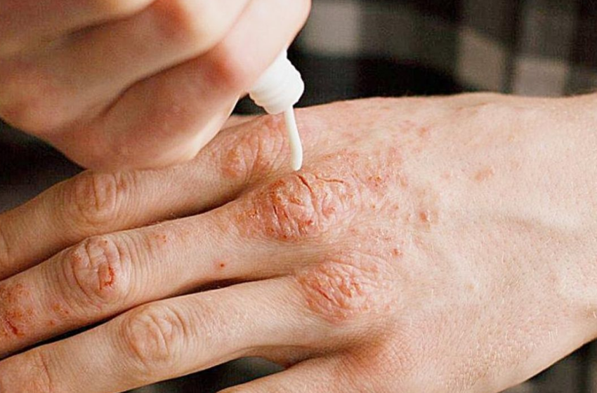  Realiza búsqueda intencionada de casos de lepra