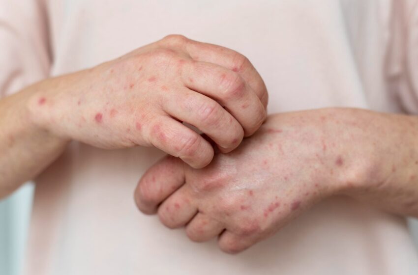  Sarampión en México: Salud confirma la primera muerte en 2026