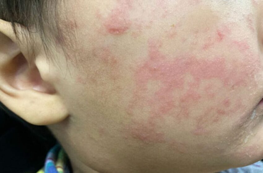  Suman 32 muertes por sarampión; ¿qué estados reportan más casos?